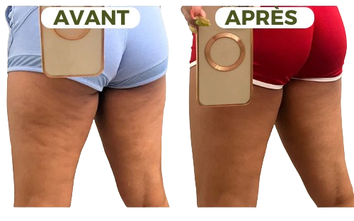Ventouse Massante – Anti-Cellulite