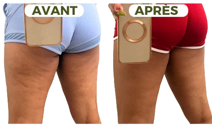 Ventouse Massante – Anti-Cellulite