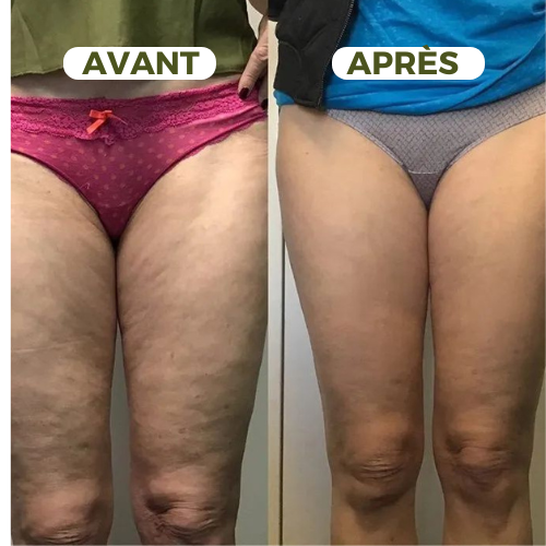 Ventouse Massante – Anti-Cellulite