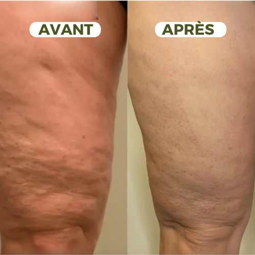 Ventouse Massante – Anti-Cellulite